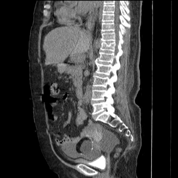File:Acute tubular necrosis (Radiopaedia 28077-28334 H 44).jpg