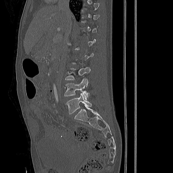 File:Acute vertebral body compression fractures (Radiopaedia 31757-32693 Sagittal bone window 35).jpg