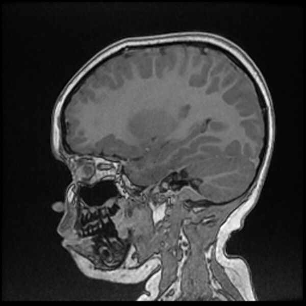 File:Adamantinomatous craniopharyngioma (Radiopaedia 77407-89529 Sagittal T1 C+ 45).jpg