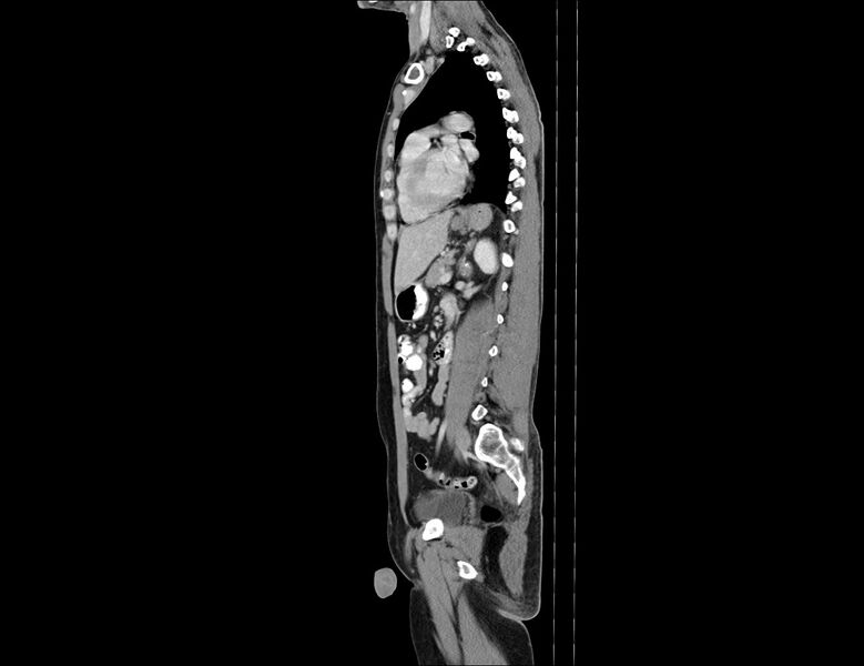 File:Addison disease (Radiopaedia 49318-54412 Sagittal C+ portal venous phase 27).jpg