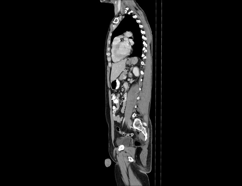 Addison disease (Radiopaedia 49318-54412 Sagittal C+ portal venous phase 27).jpg