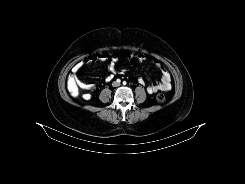 File:Adenocarcinoma of pancreas with hepatic metastasis (Radiopaedia 64332-73122 Axial C+ portal venous phase 64).jpg