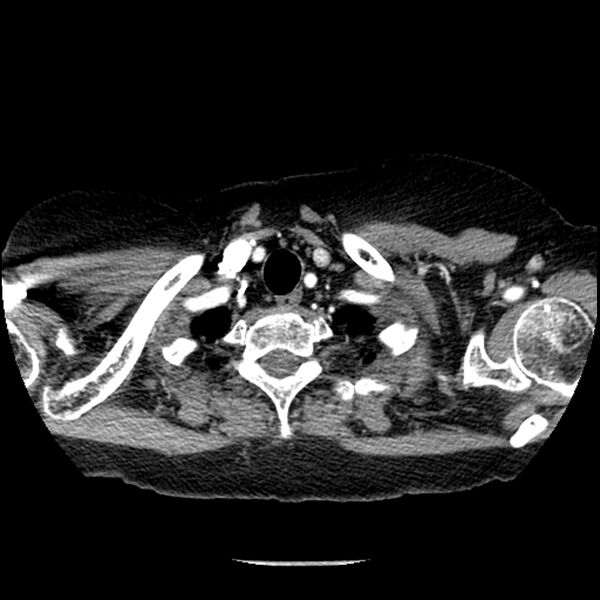File:Adenocarcinoma of the lung (Radiopaedia 41015-43755 Axial C+ portal venous phase 8).jpg