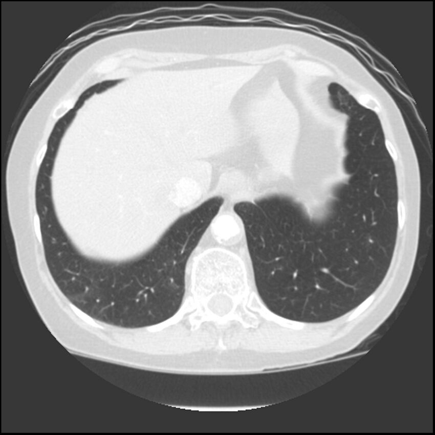 Adenocarcinoma of the lung (Radiopaedia 41015-43755 Axial lung window 106).jpg