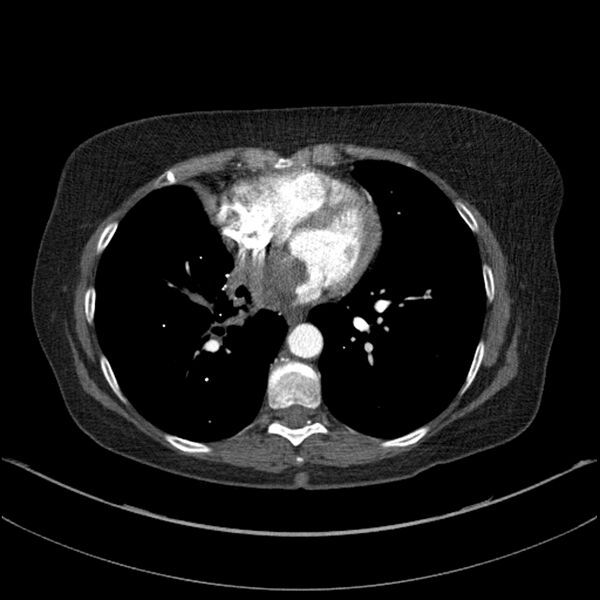 File:Adenocarcinoma of the lung (Radiopaedia 44205-47803 Axial C+ portal venous phase 55).jpg