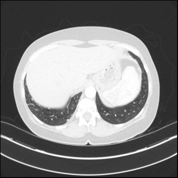File:Adenocarcinoma of the lung (Radiopaedia 44205-47803 Axial lung window 78).jpg