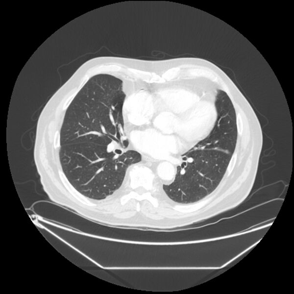 File:Adenocarcinoma of the lung (Radiopaedia 44876-48759 Axial lung window 47).jpg