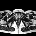 Adenomyoma of the uterus (huge) (Radiopaedia 9870-10438 Axial T2 4).jpg