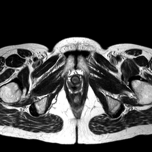 File:Adenomyoma of the uterus (huge) (Radiopaedia 9870-10438 Axial T2 4).jpg