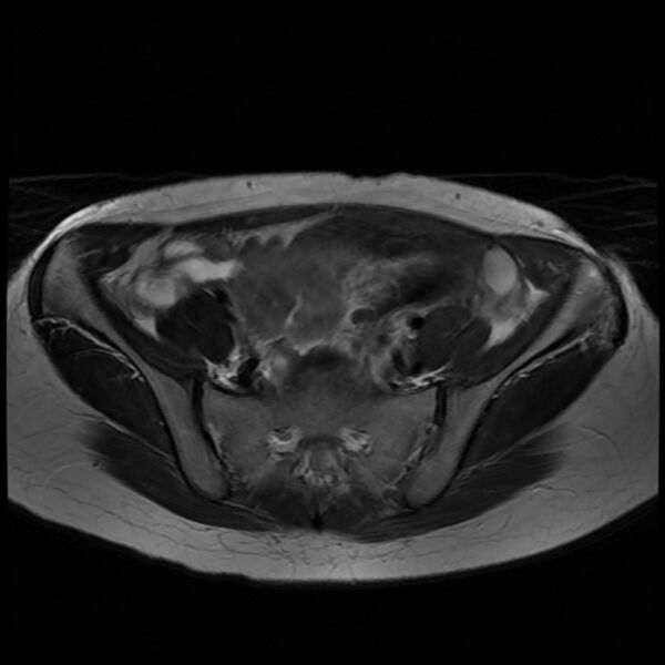 File:Adenomyosis on MRI (Radiopaedia 29328-29780 Axial T2 1).jpg