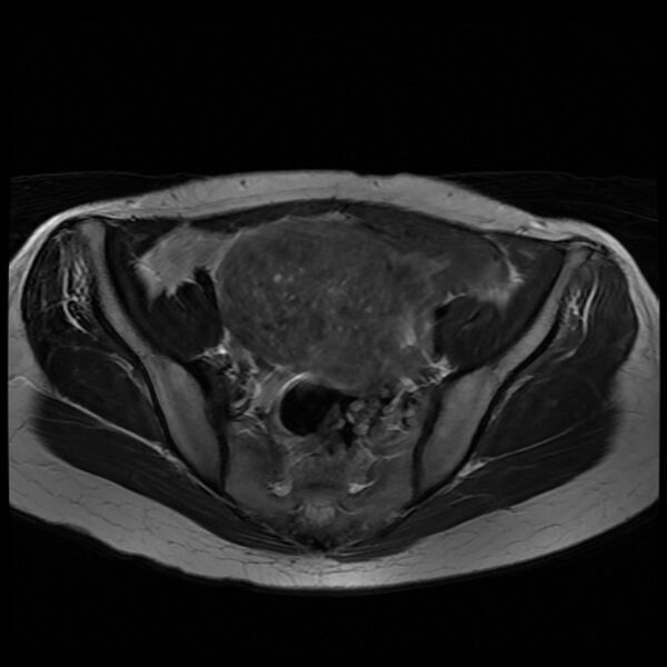 File:Adenomyosis on MRI (Radiopaedia 29328-29780 Axial T2 3).jpg