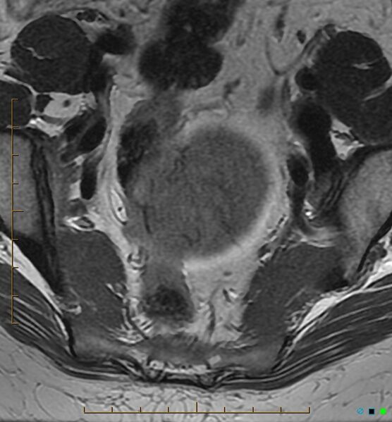 File:Adenomyosis uterus with hematometra (Radiopaedia 45779-50011 Axial T2 5).jpg