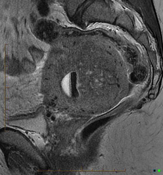 File:Adenomyosis uterus with hematometra (Radiopaedia 45779-50011 Sagittal T2 12).jpg