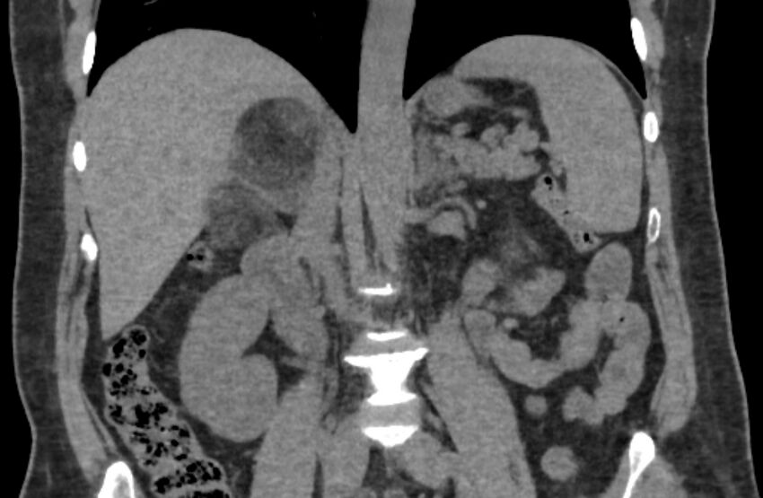 Adrenal myelolipoma (Radiopaedia 65240-74253 Coronal non-contrast 22).jpg