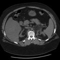 Adrenal myelolipoma (Radiopaedia 8216-9068 Axial non-contrast 18).jpg