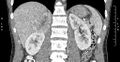 Adrenal pheochromocytoma (Radiopaedia 35133-36726 Coronal C+ portal venous phase 28).jpg