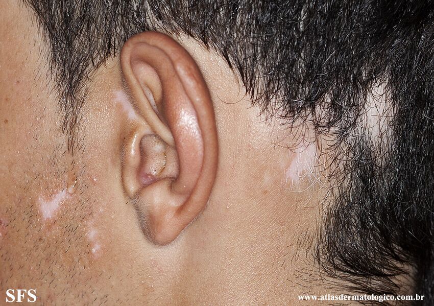 Alopecia Areata And Vitiligo (Dermatology Atlas 4).jpg