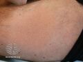 Alopecia mucinosa (DermNet NZ hair-nails-sweat-alop-mucin1).jpg