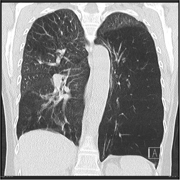 File:Alpha-1-antitrypsin deficiency (Radiopaedia 26537-26678 Coronal lung window 22).jpg