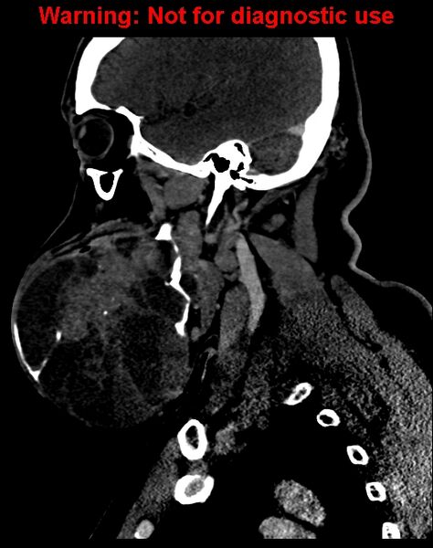 File:Ameloblastoma (Radiopaedia 33126-34164 F 23).jpg