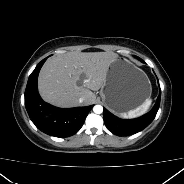 File:Ampullary tumor (Radiopaedia 22787-22816 B 14).jpg