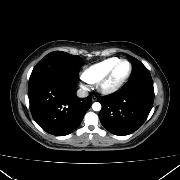 File:Ampullary tumor (Radiopaedia 22787-22816 B 2).jpg