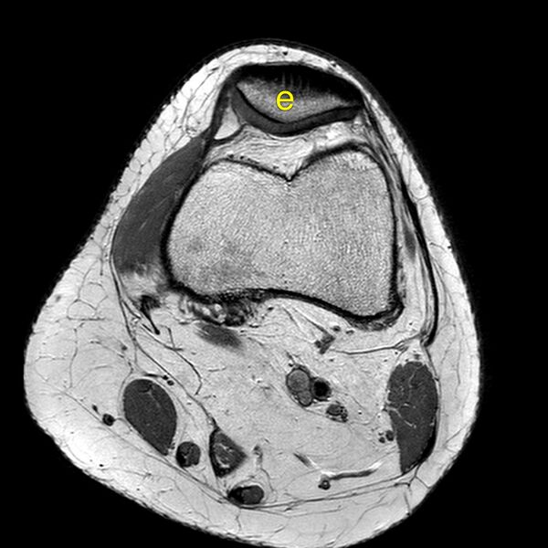 File:Anatomy Quiz (MRI knee) (Radiopaedia 43478-46866 A 6).jpeg