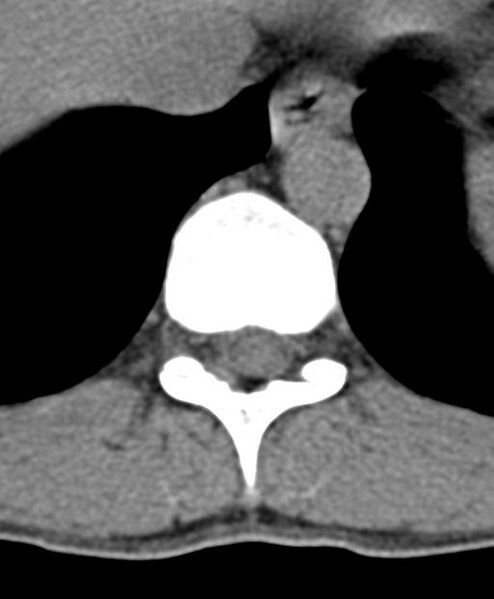File:Aneurysmal bone cyst T11 (Radiopaedia 29294-29721 Axial non-contrast 36).jpg