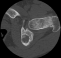 Aneurysmal bone cyst of ischium (Radiopaedia 25957-26094 B 22).png