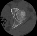 Aneurysmal bone cyst of ischium (Radiopaedia 25957-26094 B 6).png