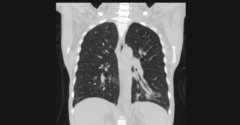 File:Angioinvasive aspergellosis (Radiopaedia 66995-76315 Coronal lung window 39).jpg