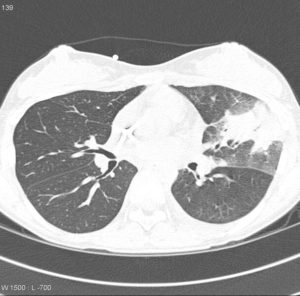File:Angioinvasive aspergillosis (Radiopaedia 8651-9466 Axial lung window 7).jpg