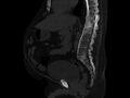 Ankylosing spondylitis (Radiopaedia 44609-48357 Sagittal bone window 52).jpg