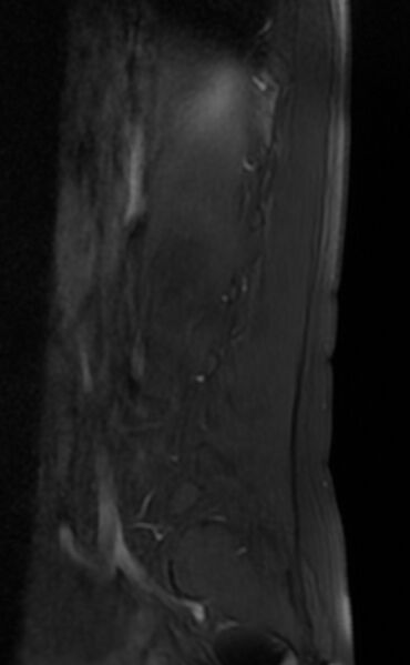 File:Ankylosing spondylitis - Andersson lesion (Radiopaedia 81878-95838 Sagittal T1 fat sat 2).jpg