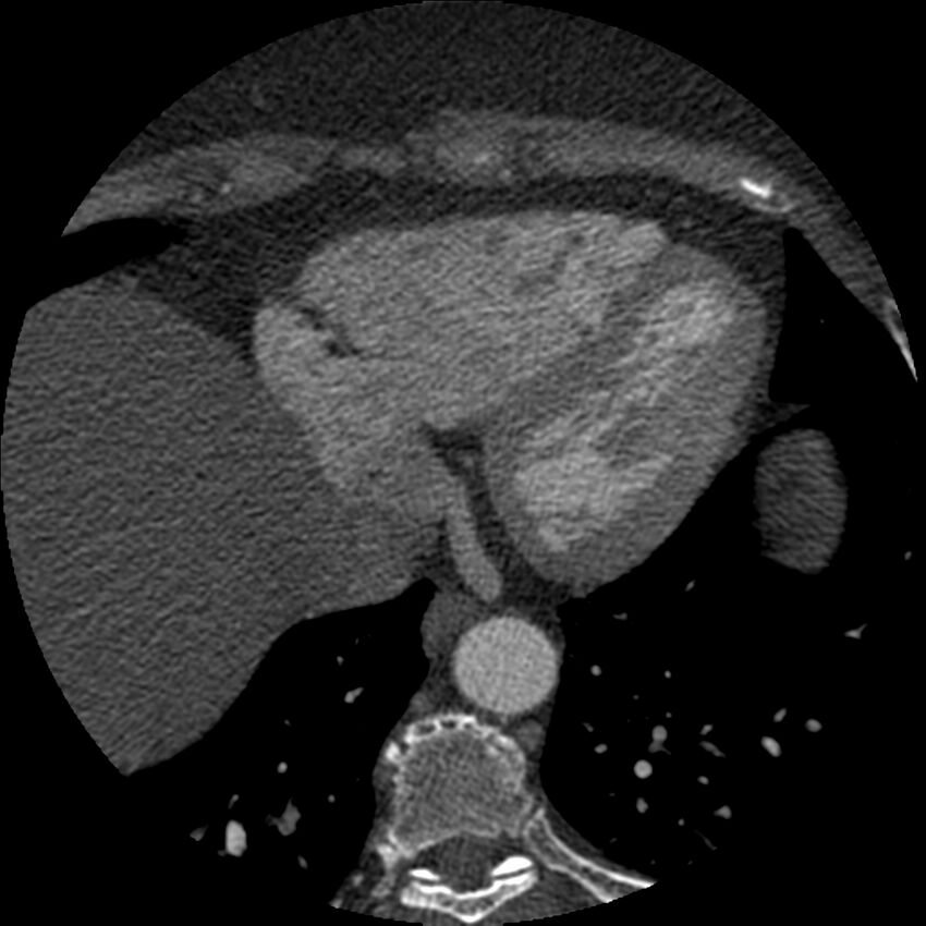 Anomalous origin of left circumflex artery from right coronary sinus (Radiopaedia 72563-83117 B 138).jpg