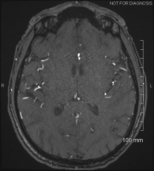 File:Anterior cerebral artery aneurysm (Radiopaedia 80683-94127 Axial MRA 135).jpg
