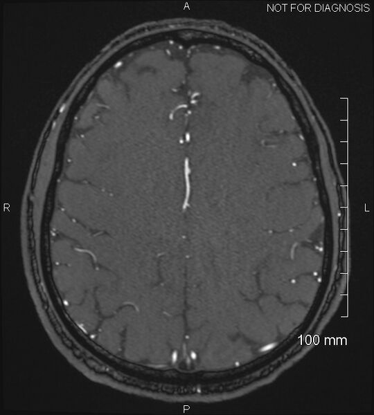 File:Anterior cerebral artery aneurysm (Radiopaedia 80683-94127 Axial MRA 178).jpg