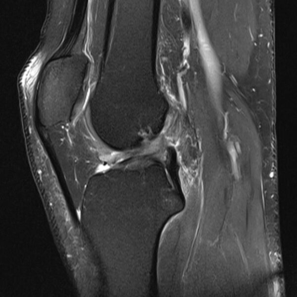 File:Anterior cruciate ligament tear - ramp lesion (Radiopaedia 71883-82322 Sagittal PD fat sat 13).jpg