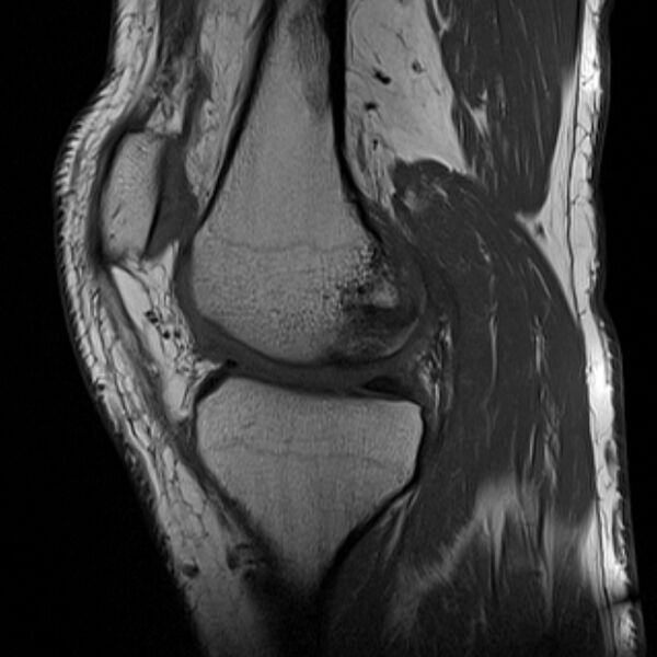 File:Anterior cruciate ligament tear - ramp lesion (Radiopaedia 71883-82322 Sagittal T1 16).jpg