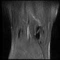 Anterior cruciate ligament tear with posteromedial corner injury, bucket-handle meniscal tear and chondral delamination (Radiopaedia 75501-86744 Coronal PD fat sat 23).jpg