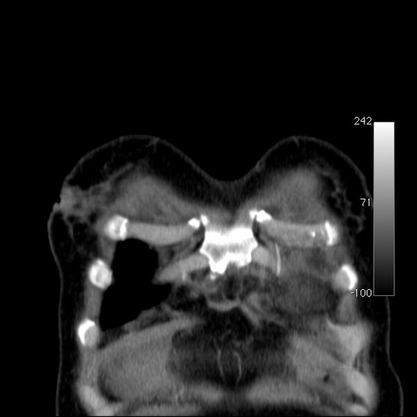 File:Aortic dissection - Stanford type A (Radiopaedia 29247-29659 B 8).jpg