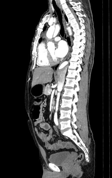 File:Aortic dissection - Stanford type A (Radiopaedia 83418-98500 B 38).jpg