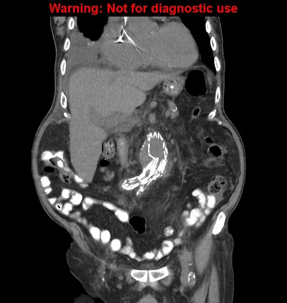 File:Aortic graft infection (Radiopaedia 44979-48907 non-contrast 20).jpg