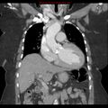 Aortic valve stenosis (Radiopaedia 14480-14423 A 8).jpg