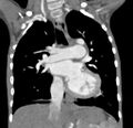 Aortopulmonary window, interrupted aortic arch and large PDA giving the descending aorta (Radiopaedia 35573-37074 D 36).jpg