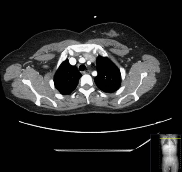 File:Appendicitis (CT angiogram) (Radiopaedia 154713-127660 Axial 227).jpg