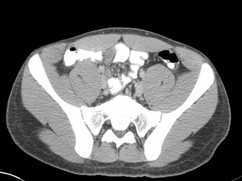 File:Appendicitis and incidental foregut duplication cyst (Radiopaedia 52962-58916 A 69).jpg