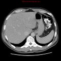 Appendicitis and renal cell carcinoma (Radiopaedia 17063-16760 A 9).jpg