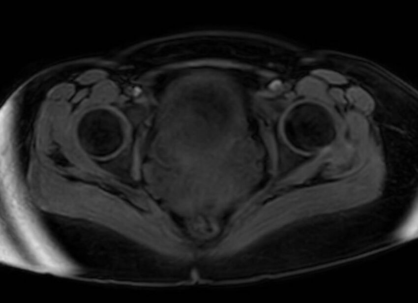 Appendicitis in gravida (MRI) (Radiopaedia 89433-106395 Axial DIXON 140).jpg