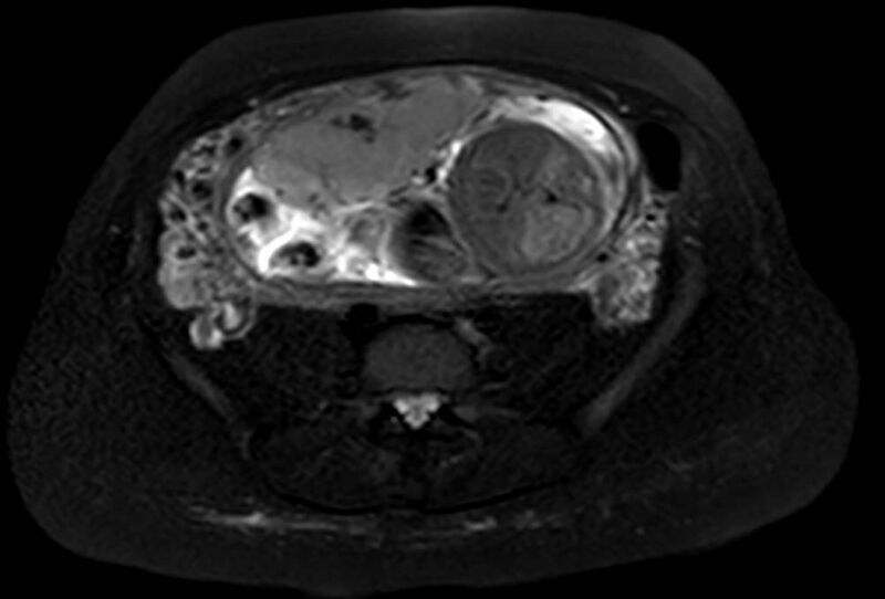 File:Appendicitis in gravida (MRI) (Radiopaedia 89433-106395 Axial T2 SPAIR 50).jpg